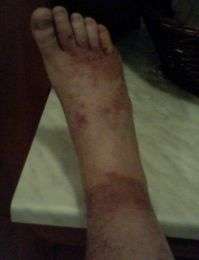 Sarcoma.di .Kaposi.4