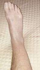 Sarcoma.di .Kaposi.guarito 1